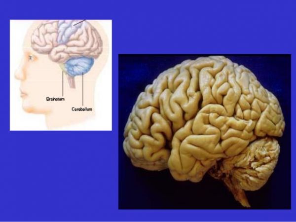 Hội chứng tiểu não - Triệu chứng, nguyên nhân và cách điều trị