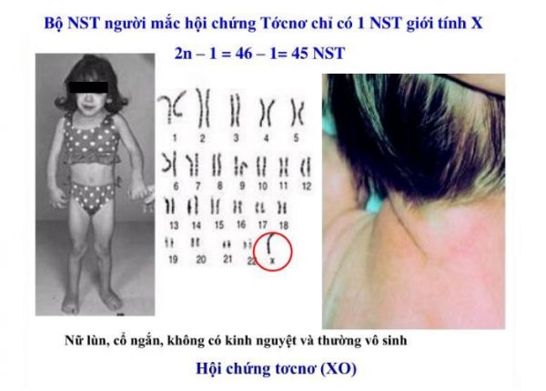 Hội chứng Turner - Triệu chứng, nguyên nhân và cách điều trị