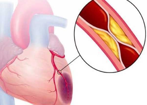 Hội chứng vành cấp - Triệu chứng, nguyên nhân và cách điều trị