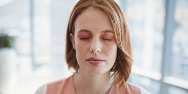 Bệnh rosacea mắt - Triệu chứng, nguyên nhân và cách điều trị