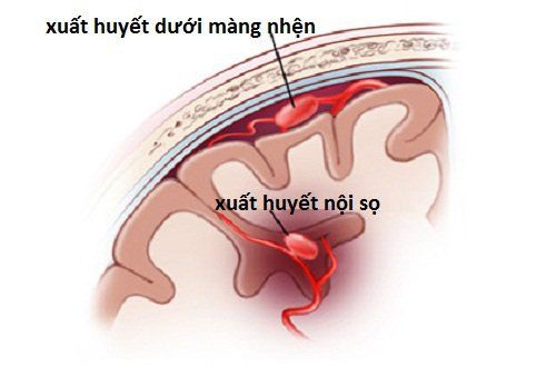 Bệnh xuất huyết dưới nhện - Triệu chứng, nguyên nhân và cách điều trị