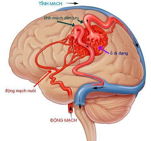 Bệnh xuất huyết não - Triệu chứng, nguyên nhân và cách điều trị