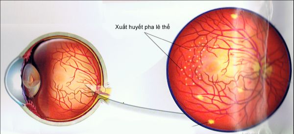 Bệnh xuất huyết võng mạc - Triệu chứng, nguyên nhân và cách điều trị