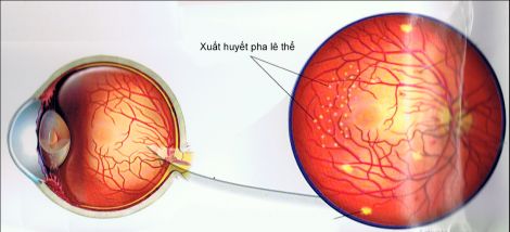 Bệnh xuất huyết võng mạc - Triệu chứng, nguyên nhân và cách điều trị