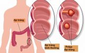 Đa polyp gia đình - Triệu chứng, nguyên nhân và cách điều trị