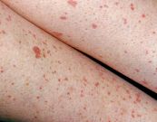 Hội chứng rối loạn sinh tủy - Triệu chứng, nguyên nhân và cách điều trị