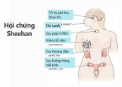 Hội chứng Sheehan - Triệu chứng, nguyên nhân và cách điều trị