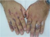 Hội chứng Sweet - Triệu chứng, nguyên nhân và cách điều trị