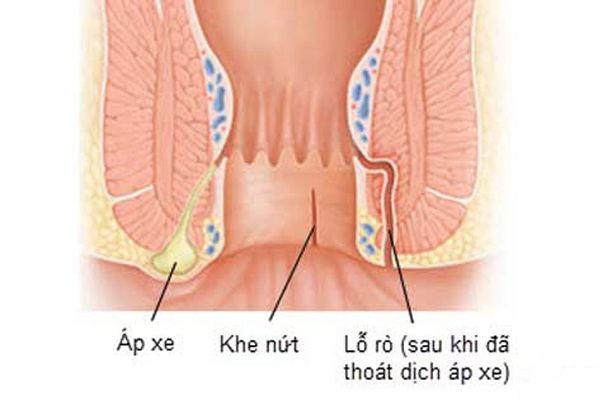 Bệnh áp-xe hậu môn - Triệu chứng, nguyên nhân và cách điều trị