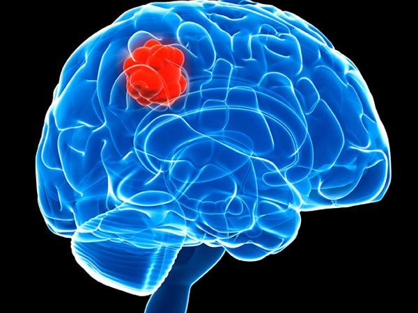 Bệnh áp xe não - Triệu chứng, nguyên nhân và cách điều trị