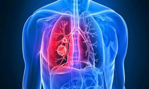 Bệnh áp xe phổi - Triệu chứng, nguyên nhân và cách điều trị