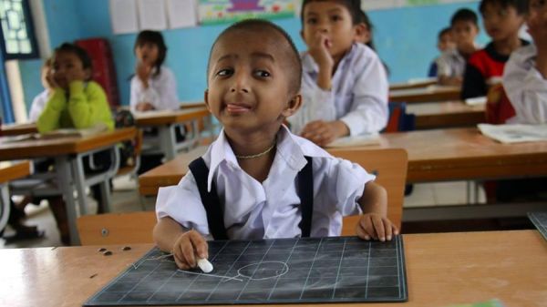 Hội chứng Seckel - Triệu chứng, nguyên nhân và cách điều trị