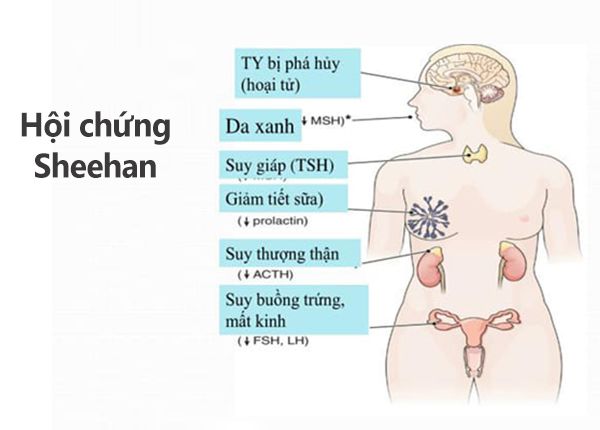 Hội chứng Sheehan - Triệu chứng, nguyên nhân và cách điều trị