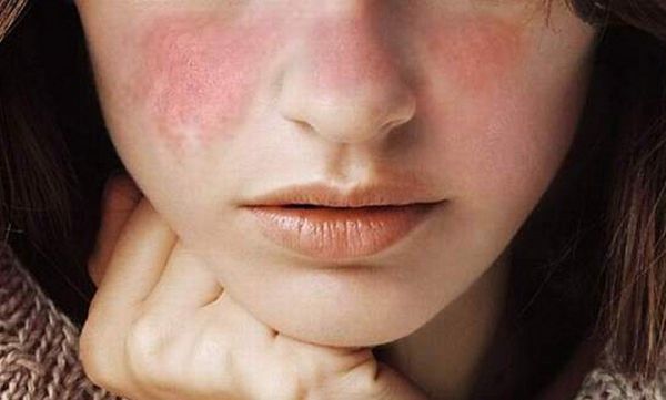 Hội chứng Sjogren - Triệu chứng, nguyên nhân và cách điều trị