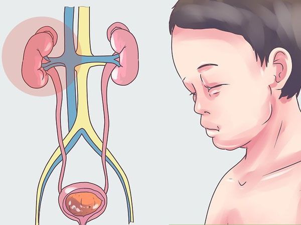 Hội chứng thận hư - Triệu chứng, nguyên nhân và cách điều trị
