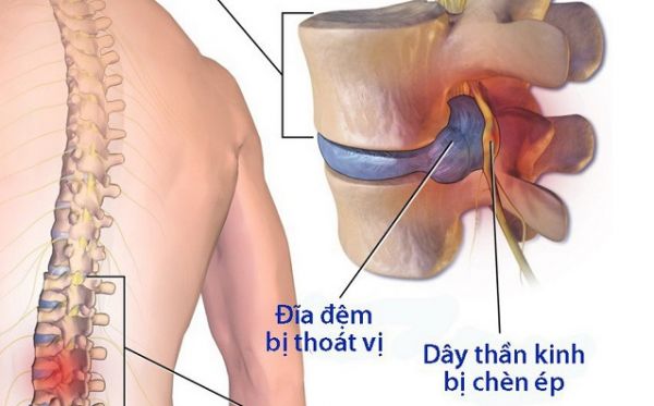 Hội chứng thắt lưng hông - Triệu chứng, nguyên nhân và cách điều trị