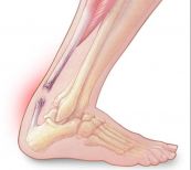 Bệnh đứt gân - Triệu chứng, nguyên nhân và cách điều trị