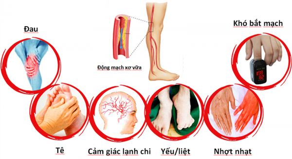 Bệnh động mạch ngoại biên - Triệu chứng, nguyên nhân và cách điều trị