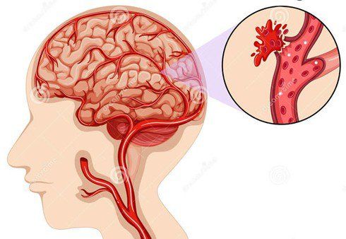 Bệnh đột quỵ xuất huyết - Triệu chứng, nguyên nhân và cách điều trị