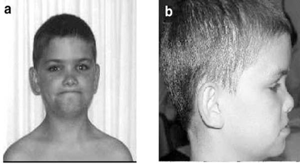 Hội chứng Aarskog-Scott - Triệu chứng, nguyên nhân và cách điều trị