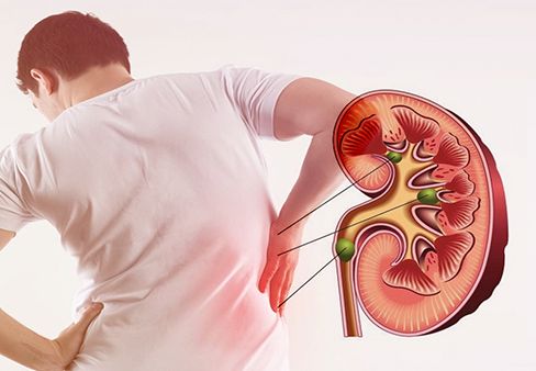 Hội chứng Abercrombie - Triệu chứng, nguyên nhân và cách điều trị