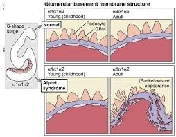 Hội chứng Alport - Triệu chứng, nguyên nhân và cách điều trị