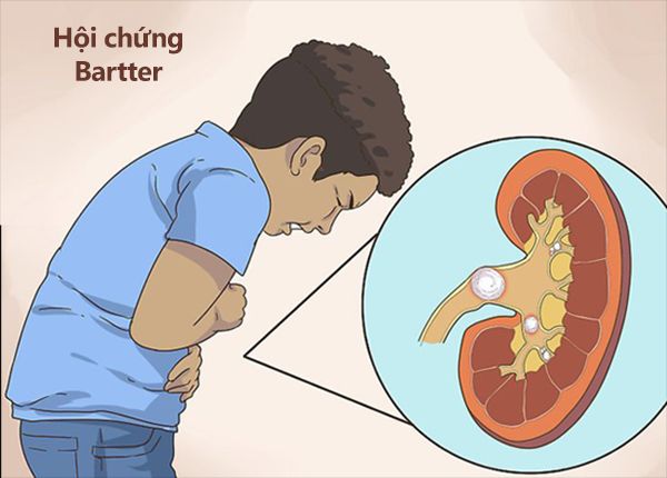 Hội chứng Bartter - Triệu chứng, nguyên nhân và cách điều trị