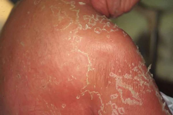 Hội chứng bong vảy da do tụ cầu - Triệu chứng, nguyên nhân và cách điều trị