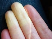Hiện tượng Raynaud - Triệu chứng, nguyên nhân và cách điều trị