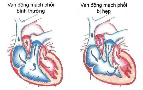 Bệnh hẹp động mạch phổi - Triệu chứng, nguyên nhân và cách điều trị