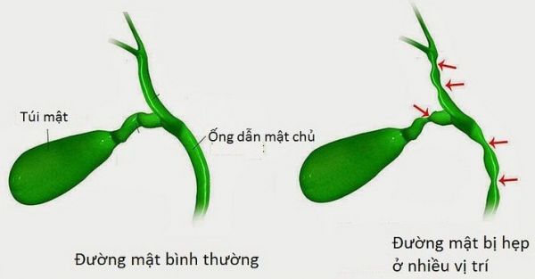 Bệnh hẹp đường mật bẩm sinh - Triệu chứng, nguyên nhân và cách điều trị