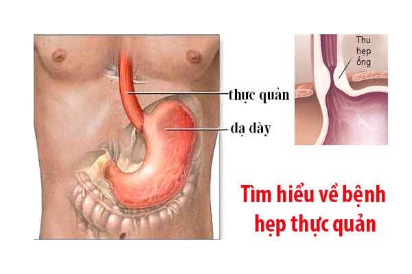 Bệnh hẹp thực quản - Triệu chứng, nguyên nhân và cách điều trị
