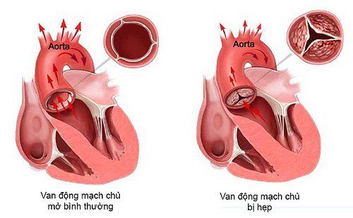 Bệnh hẹp van động mạch chủ - Triệu chứng, nguyên nhân và cách điều trị