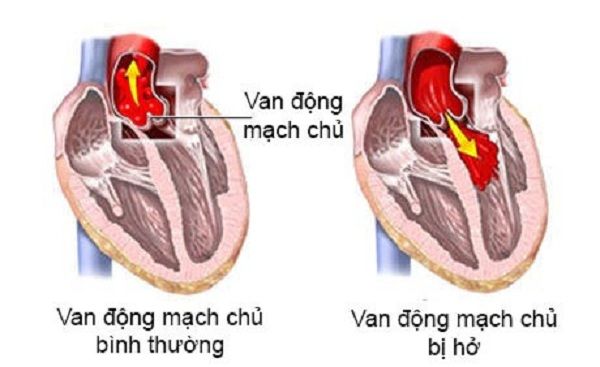 Bệnh hở van động mạch chủ - Triệu chứng, nguyên nhân và cách điều trị