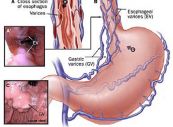 Bệnh giãn tĩnh mạch thực quản - Nguyên nhân, chẩn đoán và cách điều trị