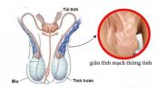 Bệnh giãn tĩnh mạch thừng tinh - Nguyên nhân, chẩn đoán và cách điều trị