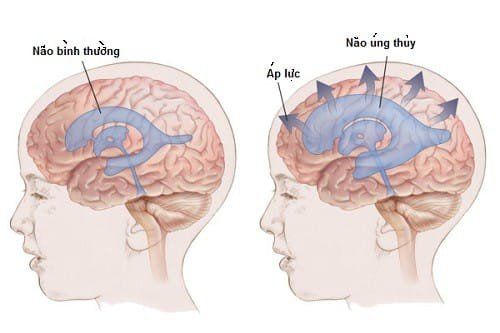 Bệnh giãn não thất - Nguyên nhân, chẩn đoán và cách điều trị