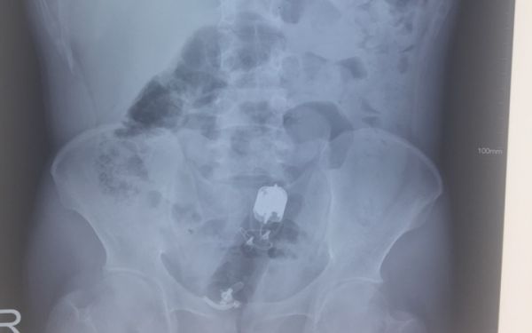 Dị vật trong trực tràng - Triệu chứng, nguyên nhân và cách điều trị