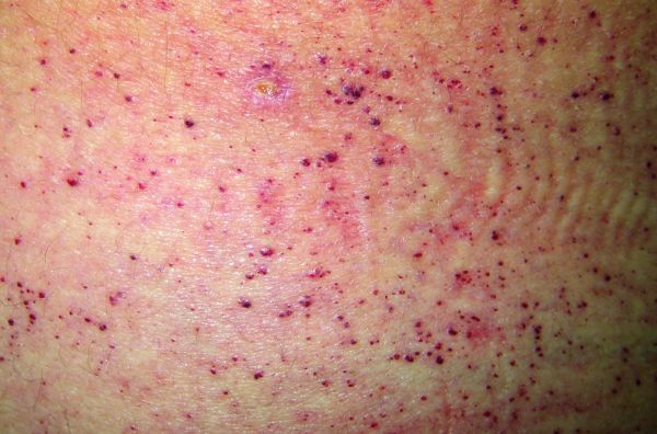 Bệnh Fabry - Triệu chứng, nguyên nhân và cách điều trị