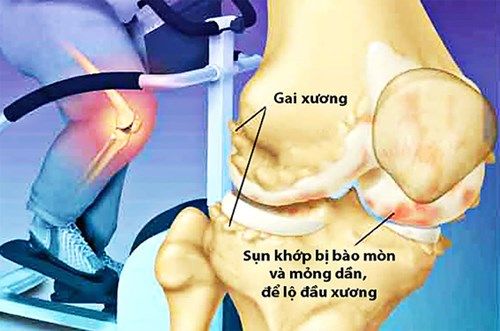 Bệnh gai xương - Triệu chứng, nguyên nhân và cách điều trị