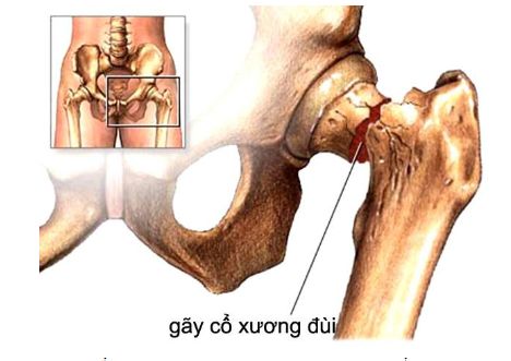 Bệnh gãy cổ xương đùi - Triệu chứng, nguyên nhân và cách điều trị
