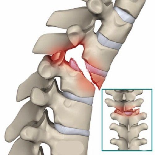 Bệnh gãy nén đốt sống - Triệu chứng, nguyên nhân và cách điều trị