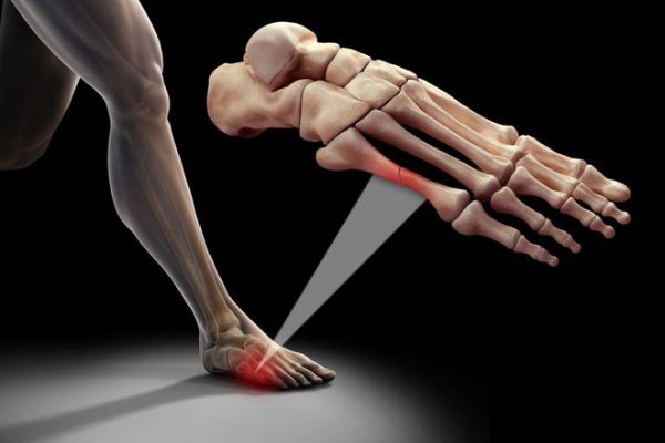 Bệnh gãy xương bàn chân - Triệu chứng, nguyên nhân và cách điều trị
