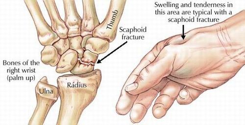 Bệnh gãy xương bàn tay - Triệu chứng, nguyên nhân và cách điều trị