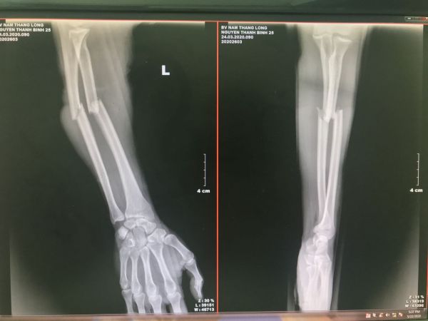 Bệnh gãy xương cẳng tay - Triệu chứng, nguyên nhân và cách điều trị