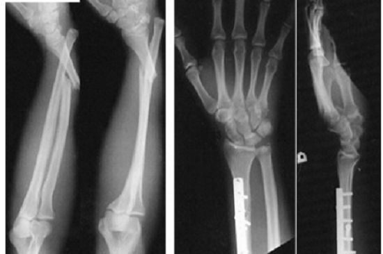Bệnh gãy xương cánh tay - Triệu chứng, nguyên nhân và cách điều trị