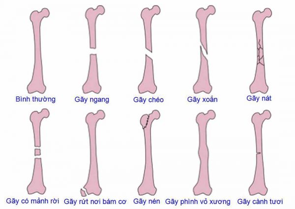 Bệnh gãy xương cành tươi - Triệu chứng, nguyên nhân và cách điều trị