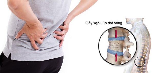 Bệnh gãy xương cột sống - Triệu chứng, nguyên nhân và cách điều trị