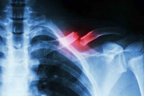 Bệnh gãy xương đòn - Triệu chứng, nguyên nhân và cách điều trị