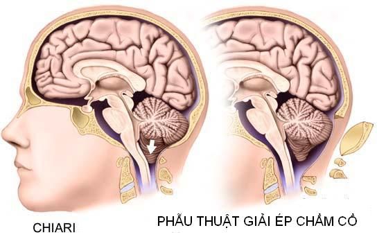 Bệnh dị dạng Chiari - Triệu chứng, nguyên nhân và cách điều trị